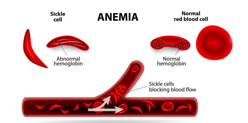 What is Sickle Cell Anaemia and How Can PGD Help?
