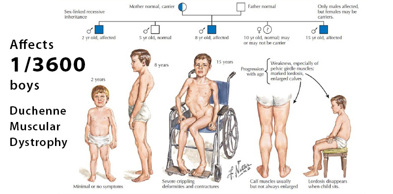 Genetic conditions that may affect your sons and daughters