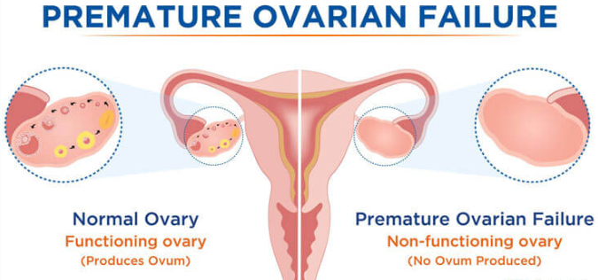 Unravelling the Mystery behind Premature Ovarian Failure