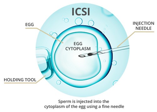 The Role Intracytoplasmic Sperm Injection (ICSI) Plays in IVF