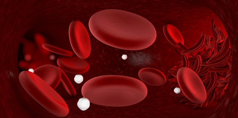 Preventing Sickle Cell Disease with PGD and Managing it