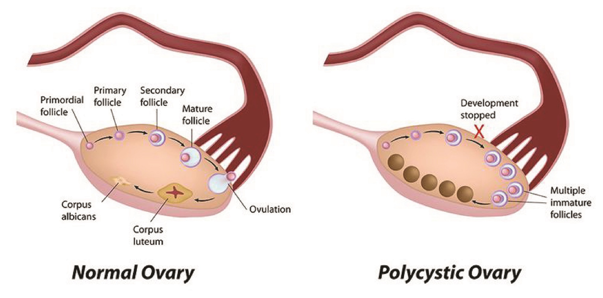 What are the causes and complications of PCOS?