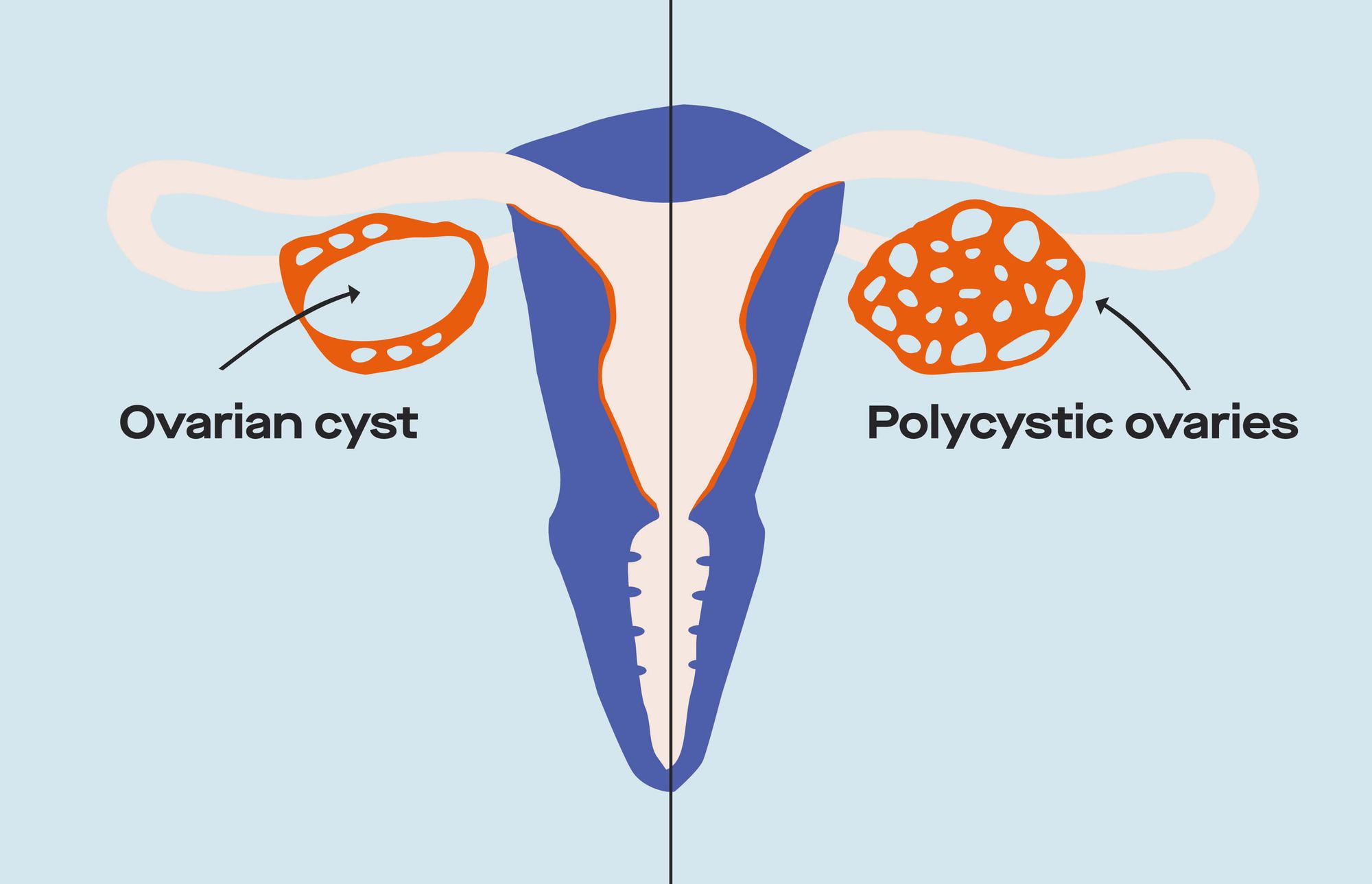Pregnancy with Ovarian Cysts and Polycystic Ovarian Syndrome.