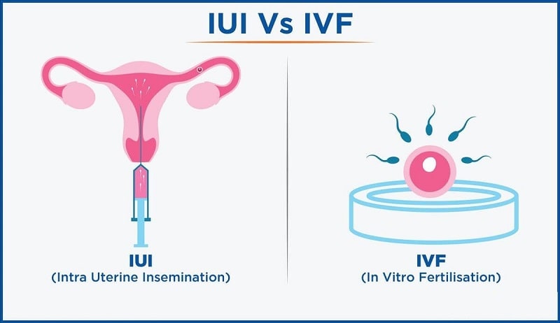 How to know if You are a Candidate for IUI