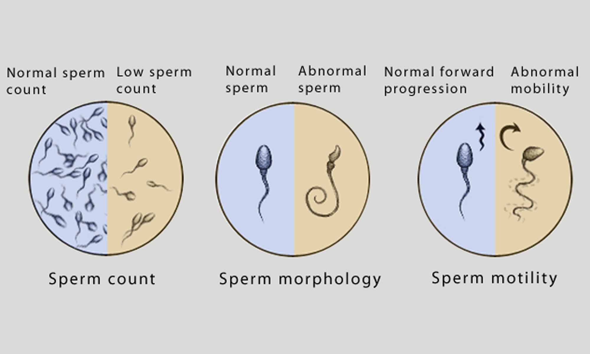 Dealing with Male Infertility